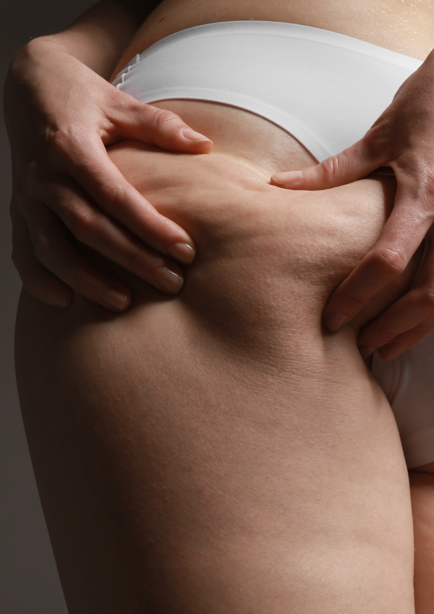 Cellulite : comprendre, agir et choisir les bons soins